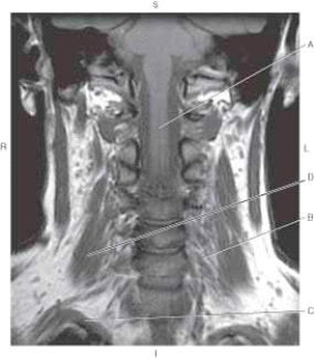 <strong>The following questions refer to the figure below of a coronal, T1-weighted MRI of cervical spine. Which line points to the middle scalene muscle?</strong> A) A B) B C) C D) D