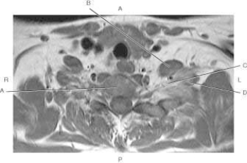 <strong>The following questions refer to the figure below of an axial, T1-weighted MRI of the thoracic spine. Which line points to the vertebral body?</strong> A) A B) B C) C D) D