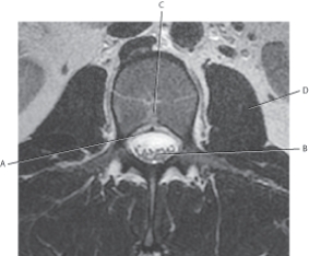 <strong>The following questions refer to the figure below of an axial, T2-weighted MRI of the lumbar vertebra. Which line points to the thecal sac?</strong> A) A B) B C) C D) D