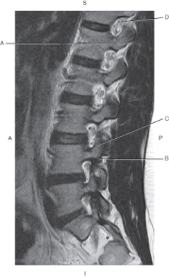 <strong>The following questions refer to the figure below of a sagittal, T2-weighted MRI of the lumbar vertebra. Which line points to the inferior articular process?</strong> A) A B) B C) C D) D