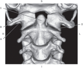 <strong>The following questions refer to the figure below of a 3D CT of the cervical vertebrae, anterior view. Which line points to the odontoid process of C2?</strong> A) A B) B C) C D) D