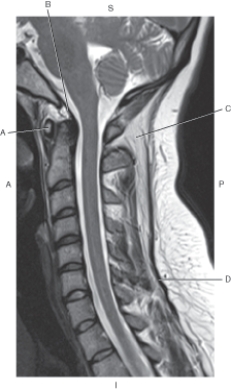 <strong>The following questions refer to the figure below of a midsagittal, T2-weighted MRI of the cervical spine with spinal ligaments. Which line points to the tectorial membrane?</strong> A) A B) B C) C D) D