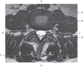 <strong>The following questions refer to the figure below of an axial, T2-weighted MRI of the lumbar spine. Which line points to the annulus fibrosis?</strong> A) A B) B C) C D) D