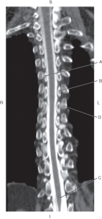 <strong>The following questions refer to the figure below of a coronal CT reformat of the thoracic spine, with intrathecal contrast. Which line points to the costotransverse joint?</strong> A) A B) B C) C D) D