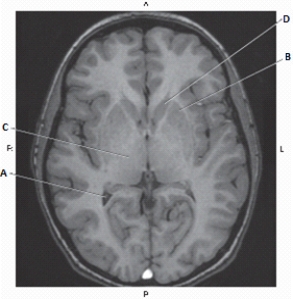 <strong>The following questions refer to the figure below of an axial, T1-weighted MR of the brain. Which line points to the head of the caudate nucleus?</strong> A) A B) B C) C D) D