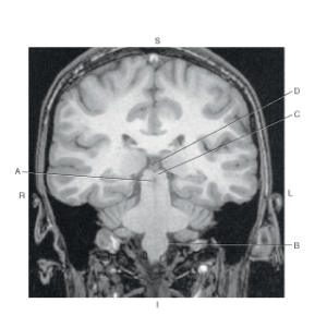 <strong>The following questions refer to the figure below of a coronal, T1-weighted MRI of the brain. Which line points to the pineal gland?</strong> A) A B) B C) C D) D