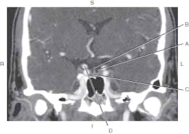 <strong>The following questions refer to the figure below of a coronal CT reformat. Which line points to the suprasellar cistern?</strong> A) A B) B C) C D) D