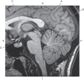 <strong>The following questions refer to the figure below of a midsagittal, T1-weighted MRI of the brainstem. Which line points to the splenium of corpus callosum?</strong> A) A B) B C) C D) D