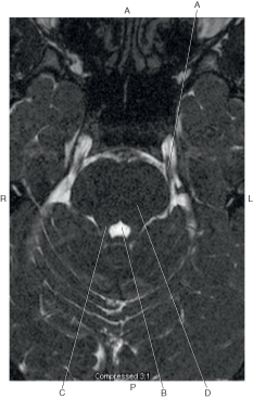 <strong>The following questions refer to the figure below of an axial, T2-weighted MRI of the brain. Which line points to the trigeminal nerve?</strong> A) A B) B C) C D) D