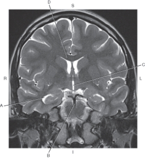 <strong>The following questions refer to the figure below of a coronal, T2-weighted MRI of the brain. Which line points to the temporal horn of lateral ventricle?</strong> A) A B) B C) C D) D