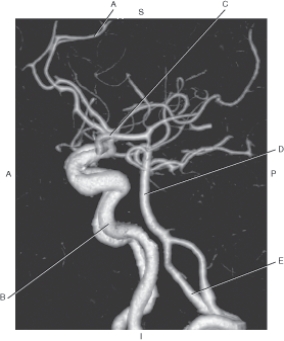 <strong>The following questions refer to the figure below of a lateral CTA of the cerebral arteries. Which line points to the vertebral artery?</strong> A) A B) B C) C D) D E) E