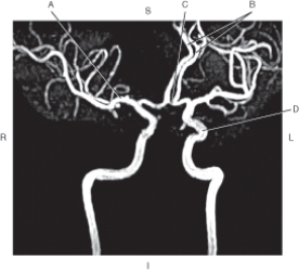 <strong>The following questions refer to the figure below of a coronal oblique MRA of the cerebral arteries. Which line points to the anterior cerebral artery?</strong> A) A B) B C) C D) D