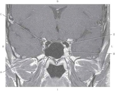 <strong>The following questions refer to the figure below of a coronal, T1-weighted MRI of the cavernous sinus with contrast enhancement. Which line points to the trigeminal nerve, maxillary division (CN V<sub>2</sub>)?</strong> A) A B) B C) C D) D
