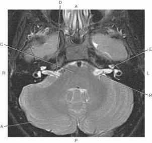 <strong>The following questions refer to the figure below of an axial, T2-weighted MRI of the brain. Which line points to cerebellum?</strong> A) A B) B C) C D) D E) E
