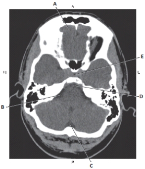 <strong>The following questions refer to the figure below of an axial CT of the brain. Which line points to the basilar artery in the prepontine cistern?</strong> A) A B) B C) C D) D E) E