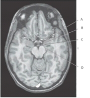<strong>The following questions refer to the figure below of an axial, T1-weighted MRI of the brain. Which line points to the mamillary body?</strong> A) A B) B C) C D) D