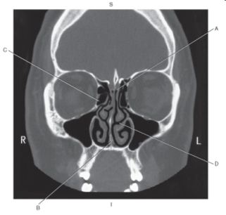 <strong>The following questions refer to the figure below of a coronal CT of the ethmoid bone. Which line points to the vomer?</strong> A) A B) B C) C D) D