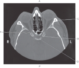 <strong>The following questions refer to the figure below of an axial CT of the orbit. Which line points to the optic canal?</strong> A) A B) B C) C D) D