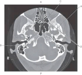 <strong>The following questions refer to the figure below of an axial CT of the temporal bone. Which line points to the sphenoid sinus?</strong> A) A B) B C) C D) D
