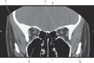 <strong>The following questions refer to the figure below of a coronal CT of the orbit. Which line points to the temporalis muscle?</strong> A) A B) B C) C D) D