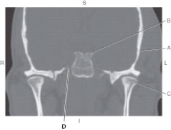 <strong>The following questions refer to the figure below of the coronal CT of the dorsum sella. Which line points to the temporal bone?</strong> A) A B) B C) C D) D