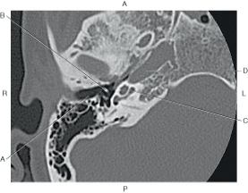 <strong>The following questions refer to the figure below of an axial CT of the inner ear. Which line points to the malleus?</strong> A) A B) B C) C D) D