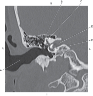 <strong>The following questions refer to the figure below of a coronal CT reformat of the inner ear. Which line points to the external auditory meatus (EAM)?</strong> A) A B) B C) C D) D E) E