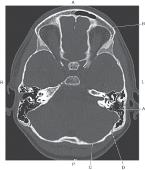 <strong>The following questions refer to the figure below of an axial CT of the cranium. Which line points to the lambdoidal suture?</strong> A) A B) B C) C D) D