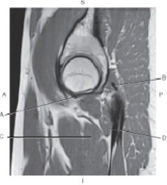 <strong>The following questions refer to the figure below of a sagittal, T1-weighted MRI of the hip. Which line is pointing to the pectineus muscle?</strong> A) A B) B C) C D) D