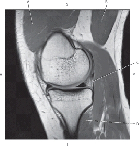 <strong>The following questions refer to the figure below of a sagittal, T1-weighted MRI of the knee. Which line is pointing to the semimembranosus muscle?</strong> A) A B) B C) C D) D