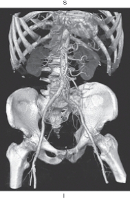 <strong>The figure below is an example of which of the following? </strong> A) Multiplanar reformation B) Shaded surface display C) Maximum intensity projection D) Volume rendering