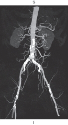 <strong>The figure below is an example of which of the following? </strong> A) Multiplanar reformation B) Shaded surface display C) Maximum intensity projection D) Volume rendering