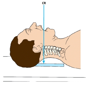 <strong>The x-ray projection demonstrated in this figure is the: </strong> A) AP cervical spine. B) AP axial cervical spine. C) AP,open mouth,atlas and axis. D) AP,Fuchs method,atlas and axis.