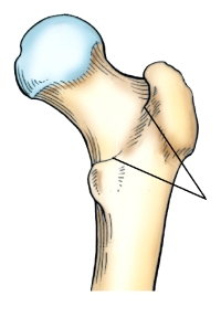 <strong>The area identified on the bone shown in this figure is the:  </strong> A) posterior inferior spine. B) lesser trochanter. C) greater trochanter. D) intertrochanteric crest. <div style=padding-top: 35px> 