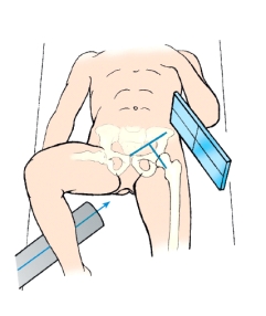 <strong>Which projection of the hip is shown in this figure?  </strong> A) Lateral B) Axiolateral C) Axiolateral oblique D) Superoinferior <div style=padding-top: 35px> 