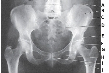 <strong>What anatomy is labeled as letter C in the image below?  </strong> A) Iliac crest B) Ala of ilium C) ASIS D) AIIS <div style=padding-top: 35px> 