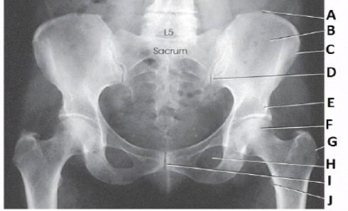 <strong>What anatomy is labeled as letter H in the image below?  </strong> A) Pubic symphysis B) Obturator foramen C) Ischial tuberosity D) Superior pubic ramus <div style=padding-top: 35px> 