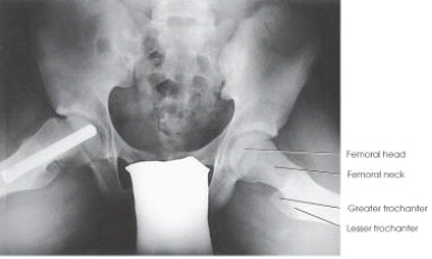 <strong>What projection and anatomy of interest is depicted in the image below?  </strong> A) AP oblique (modified Cleaves),femoral necks B) AP oblique (Cleaves),femoral necks C) AP axial (Taylor),anterior pelvic bones D) AP axial (Bridgeman),pelvic inlet <div style=padding-top: 35px> 