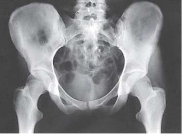 <strong>What positioning error is evident in the image below?  </strong> A) None.This image meets all evaluation criteria for this projection. B) The lower limbs were not internally rotated. C) The lower limbs were not externally rotated. D) The knees were not flexed to reduce lordotic curve. <div style=padding-top: 35px> 