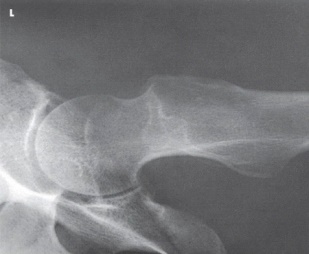 <strong>What projection (method)is demonstrated in the image below?  </strong> A) AP oblique (modified Cleaves) B) Mediolateral (Lauenstein) C) Axiolateral (Danelius-Miller) D) AP oblique (Judet) <div style=padding-top: 35px> 