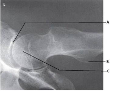 <strong>What anatomy is labeled as letter A in the image below?  </strong> A) Acetabulum B) Femoral head C) Femoral neck D) Greater trochanter <div style=padding-top: 35px> 