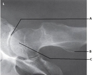 <strong>What anatomy is labeled as letter B in the image below?  </strong> A) Acetabulum B) Femoral head C) Lesser trochanter D) Iliac crest <div style=padding-top: 35px> 