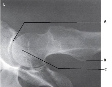 <strong>What anatomy is labeled as letter C in the image below?  </strong> A) Acetabulum B) Femoral head C) Femoral neck D) Iliac crest <div style=padding-top: 35px> 