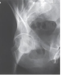 <strong>Examine this AP oblique (Judet)image of the right hip obtained with the patient positioned for the internal oblique.What patient position is depicted?  </strong> A) 45 degrees RPO B) 45 degrees LPO C) 45 degrees RAO D) 45 degrees LAO <div style=padding-top: 35px> 