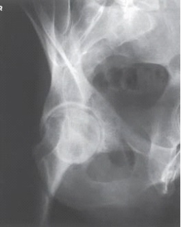 <strong>Examine this AP oblique (Judet)image of the right hip obtained with the patient positioned for the internal oblique.What is the anatomy of interest?  </strong> A) Anterior acetabular rim and iliopubic column B) Posterior acetabular rim and iliopubic column C) Anterior acetabular rim and ilioischial column D) Posterior acetabular rim and ilioischial column <div style=padding-top: 35px> 