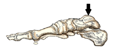 <strong>The bone of the foot indicated by the arrow in this figure is the:  </strong> A) navicular. B) talus. C) calcaneus. D) medial cuneiform. <div style=padding-top: 35px> 