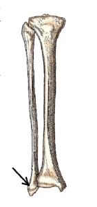 <strong>The bone part identified by the arrow in this figure is the:  </strong> A) lateral condyle. B) medial condyle. C) lateral malleolus. D) medial malleolus. <div style=padding-top: 35px> 