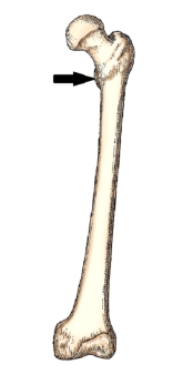 <strong>The bone part identified in this figure is the:  </strong> A) lateral condyle. B) medial condyle. C) greater trochanter. D) lesser trochanter. <div style=padding-top: 35px> 