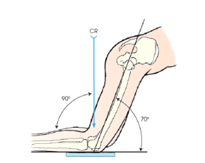 <strong>The patient position and central ray shown in this figure will demonstrate the:  </strong> A) patella. B) patellofemoral joint. C) intercondylar fossa. D) tibiofibular joint space. <div style=padding-top: 35px> 