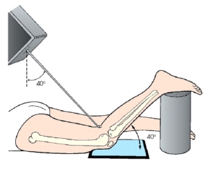 <strong>The patient position and central-ray method demonstrated in this figure is the:  </strong> A) Holmblad (intercondylar fossa). B) Camp-Coventry (intercondylar fossa). C) Settegast (patellofemoral joint). D) Hughston (patellofemoral joint). <div style=padding-top: 35px> 